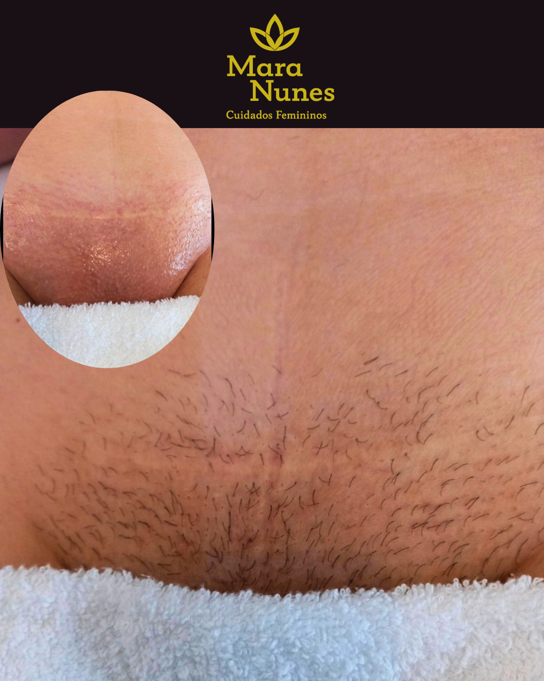 Imagem do resultado da depilação